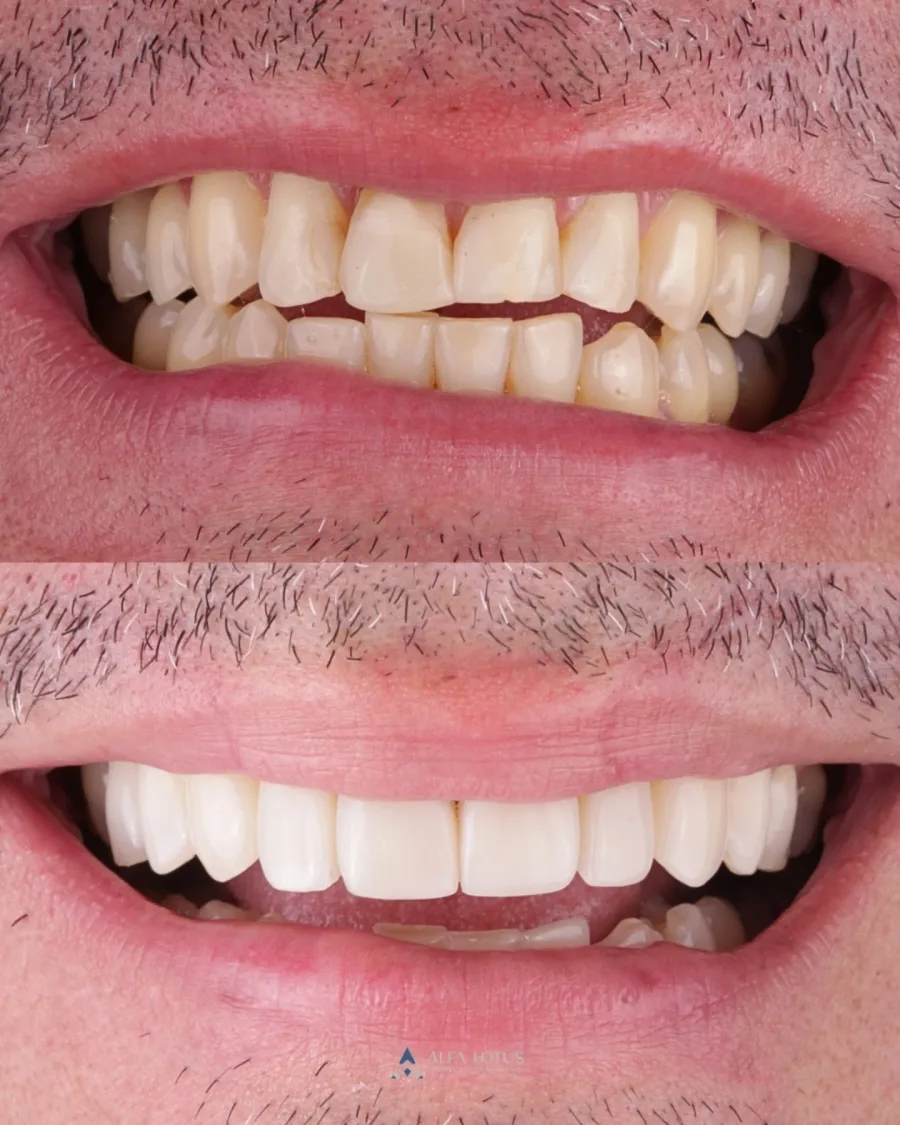 Antes e depois: clareamento com facetas em resina