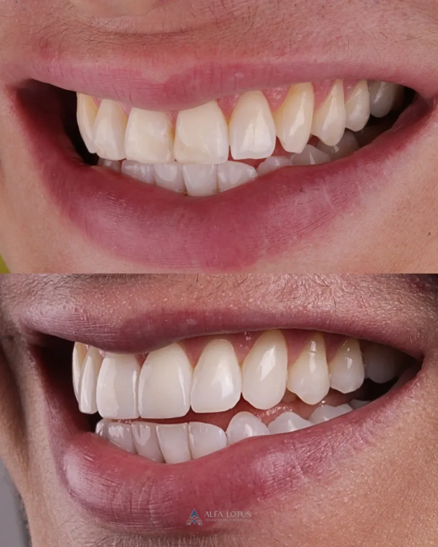 Antes e depois: substituição de resinas antigas