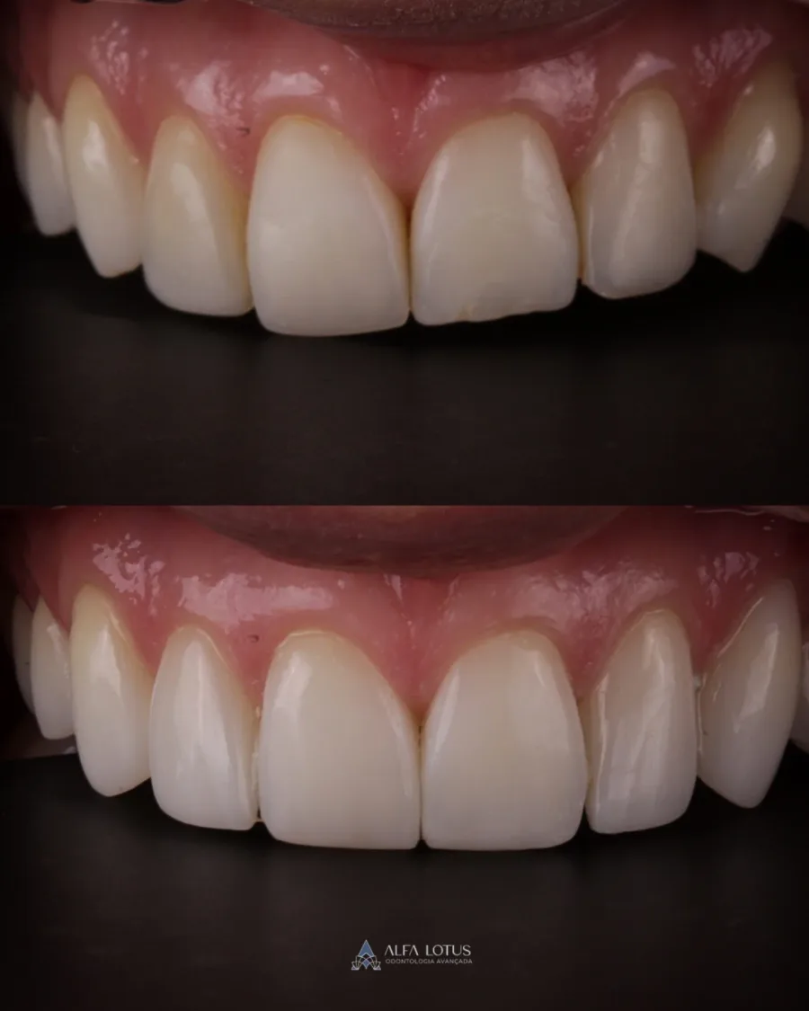 Antes e depois: clareamento e reanatomização