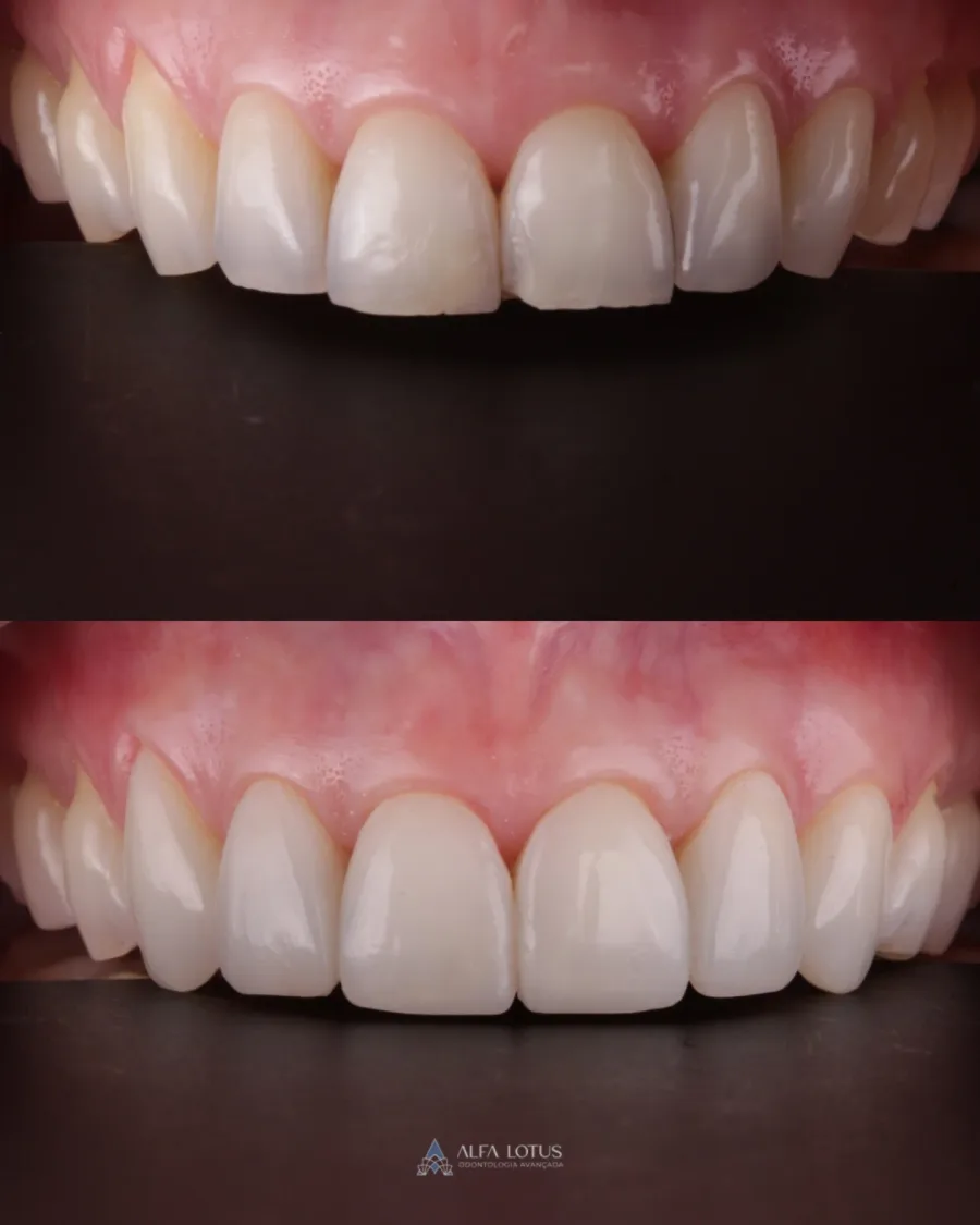 Antes e depois: facetas diretas sem desgaste